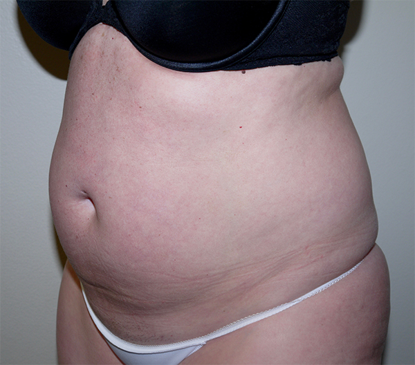 Before Image: Liposuction - left-front-oblique