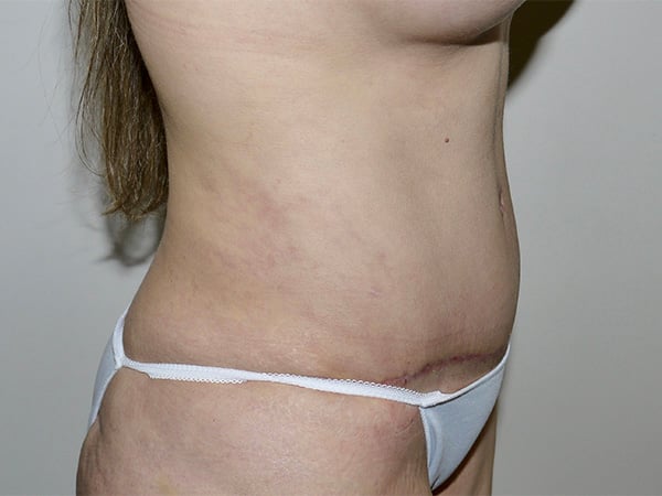 After Image: Abdominoplasty - right-front-oblique