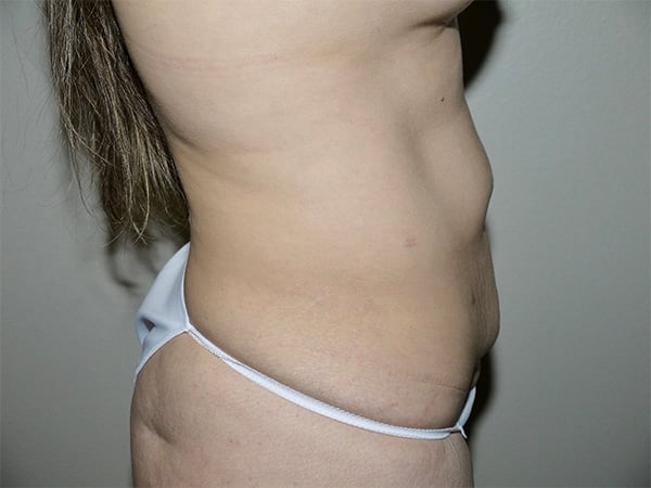 Before Image: Abdominoplasty - right-side