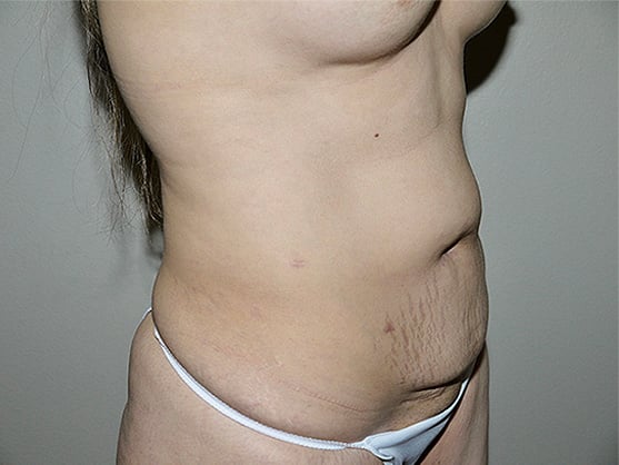 Before Image: Abdominoplasty - right-front-oblique