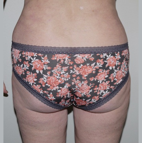 After Image: Liposuction - back