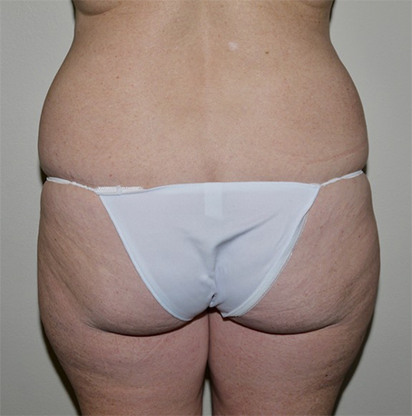 Before Image: Liposuction - back