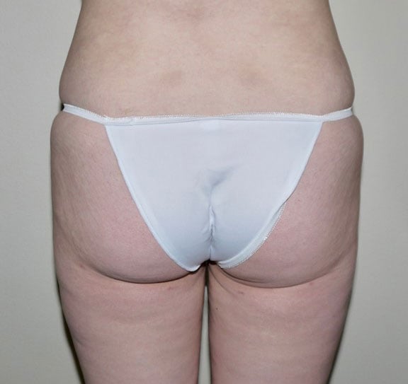 After Image: Liposuction - back