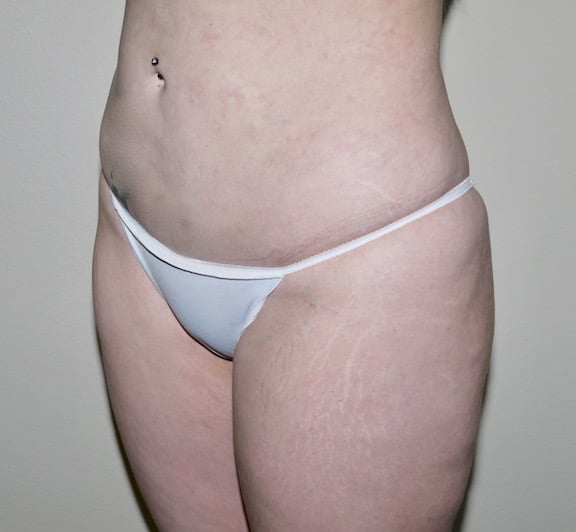 After Image: Liposuction - left-front-oblique