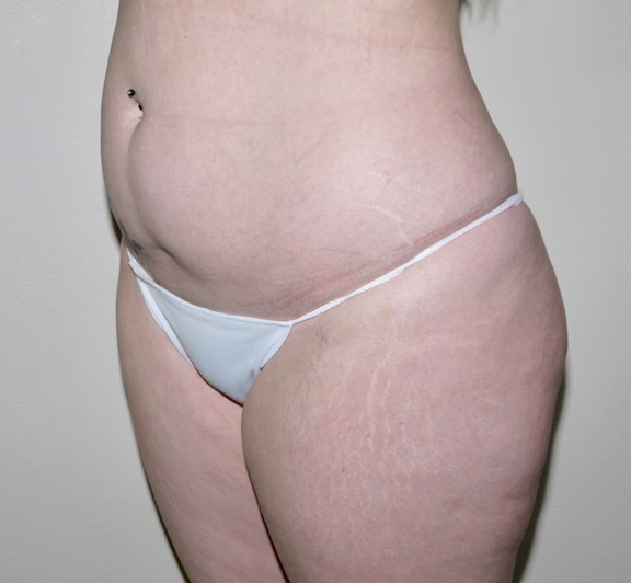 Before Image: Liposuction - left-front-oblique
