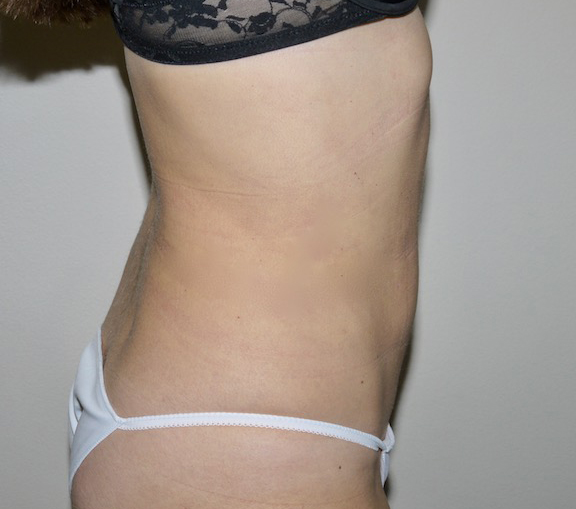 After Image: Liposuction - right-side