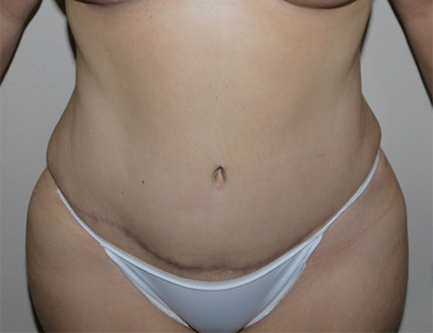 After Image: Abdominoplasty - front
