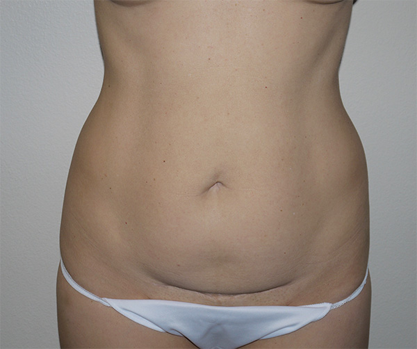 Before Image: Abdominoplasty - front