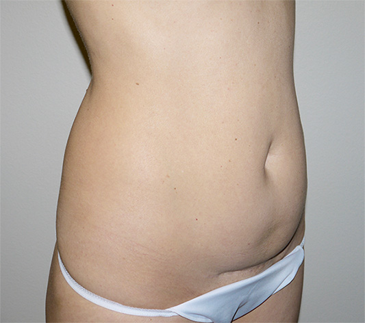 Before Image: Abdominoplasty - right-front-oblique