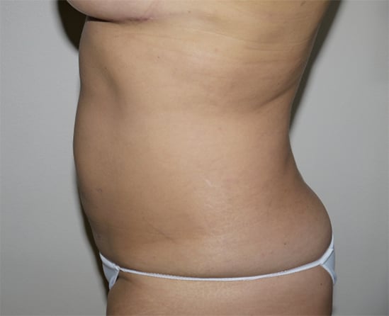 After Image: Liposuction - left-side
