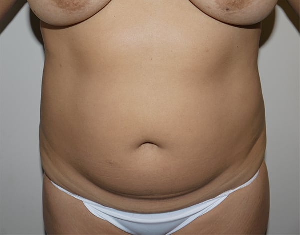 Before Image: Liposuction - front