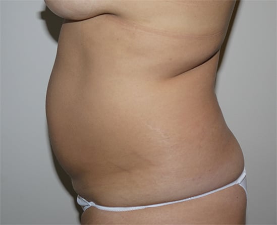 Before Image: Liposuction - left-side
