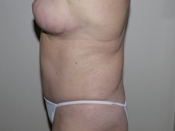 After Image: Abdominoplasty - left-side