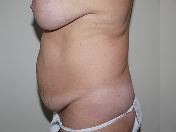 Before Image: Abdominoplasty - left-side