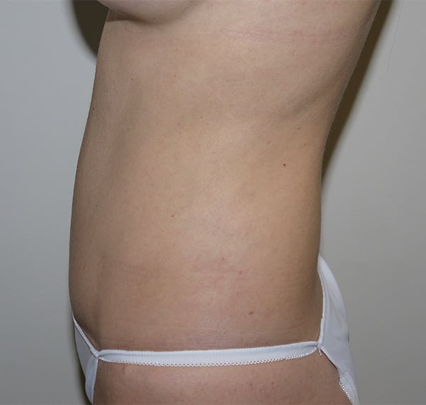 After Image: Abdominoplasty - left-side