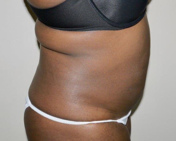After Image: Liposuction - right-side