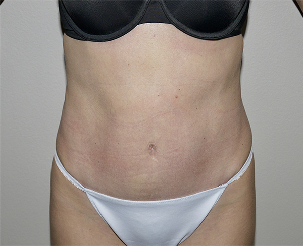 After Image: Abdominoplasty - front