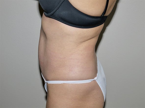 After Image: Abdominoplasty - left-side