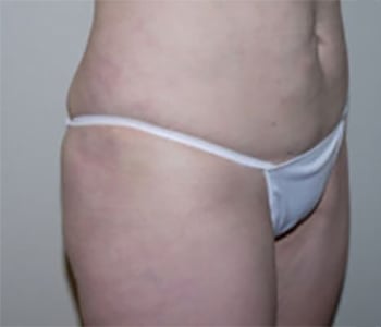 After Image: Liposuction - right-front-oblique