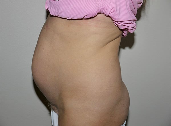 Before Image: Abdominoplasty - left-side