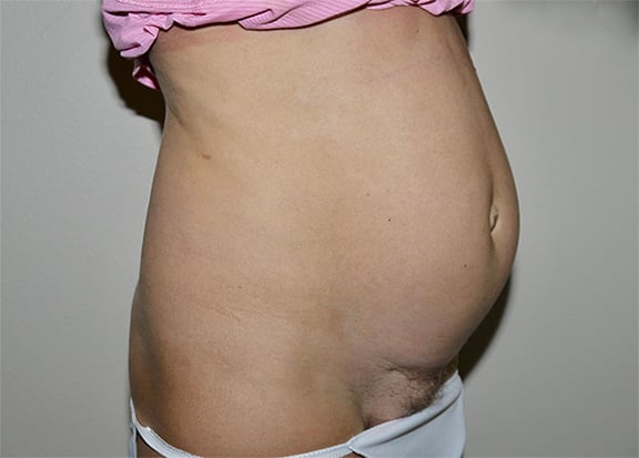 Before Image: Abdominoplasty - right-front-oblique