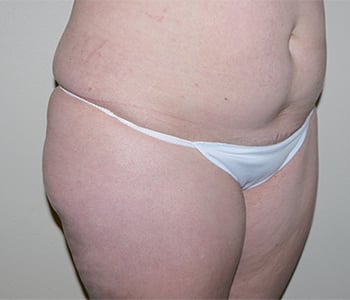 Before Image: Liposuction - right-front-oblique