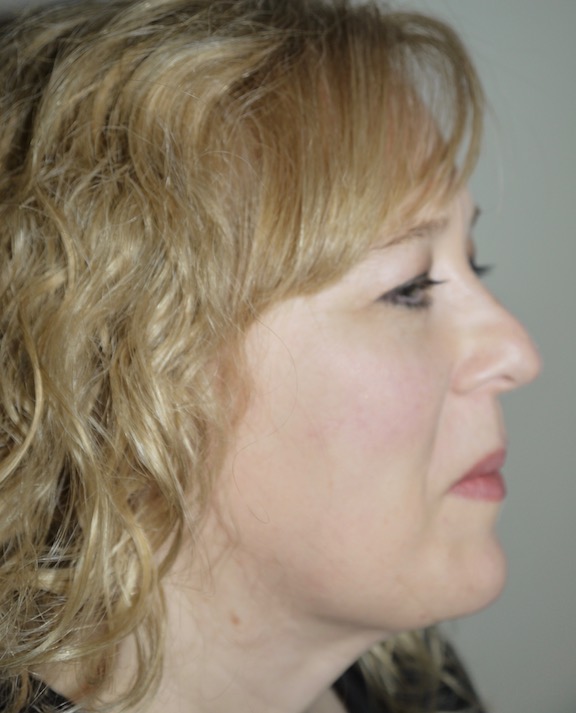 After Image: Liposuction - right-side