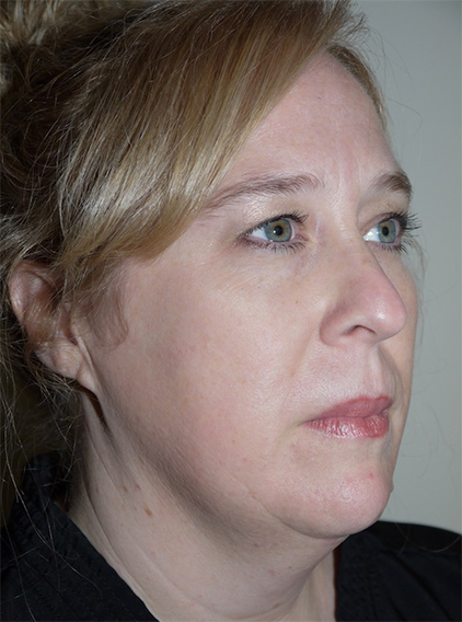 Before Image: Liposuction - right-front-oblique