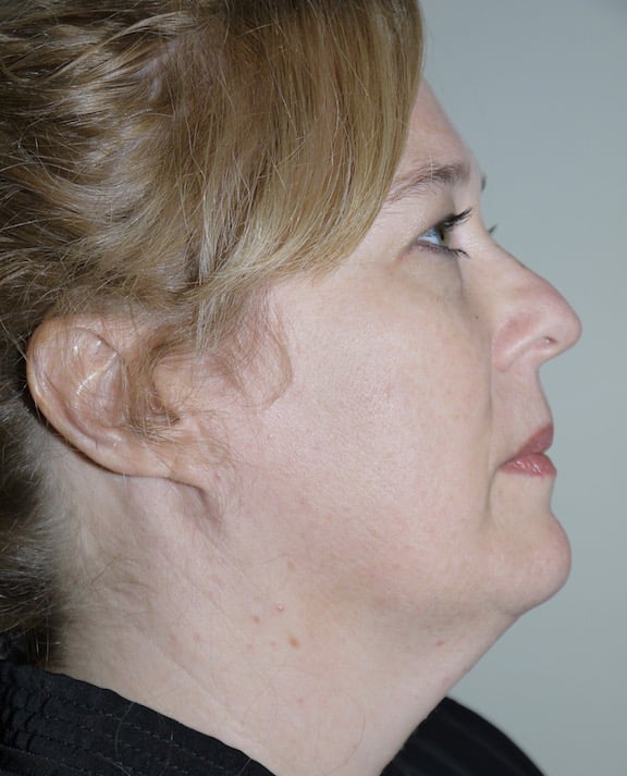 Before Image: Liposuction - right-side