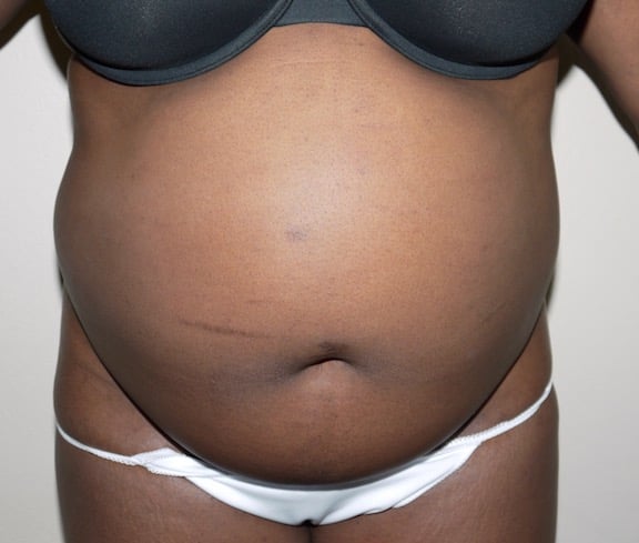 Before Image: Liposuction - front