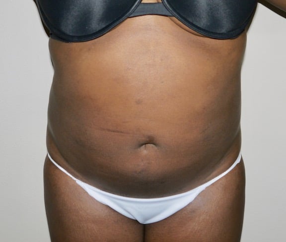 After Image: Liposuction - front