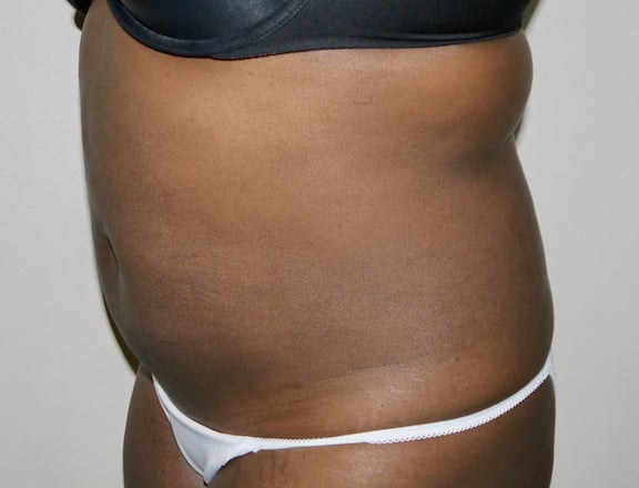 After Image: Liposuction - left-front-oblique