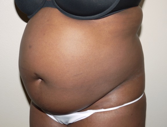 Before Image: Liposuction - left-front-oblique