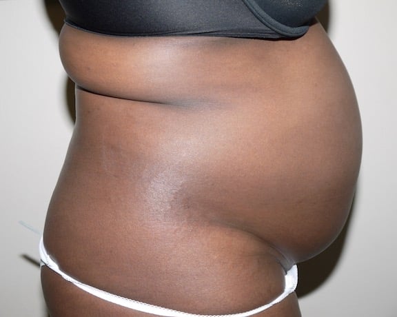 Before Image: Liposuction - right-side