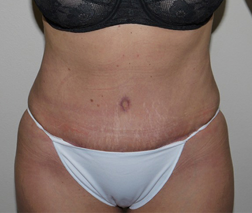 After Image: Abdominoplasty - front