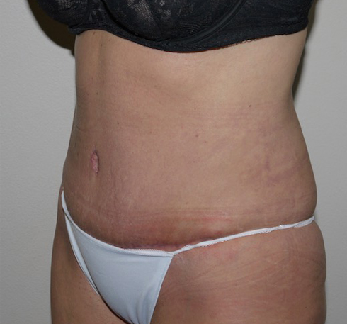 After Image: Abdominoplasty - left-front-oblique