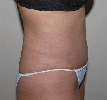 After Image: Abdominoplasty - right-side