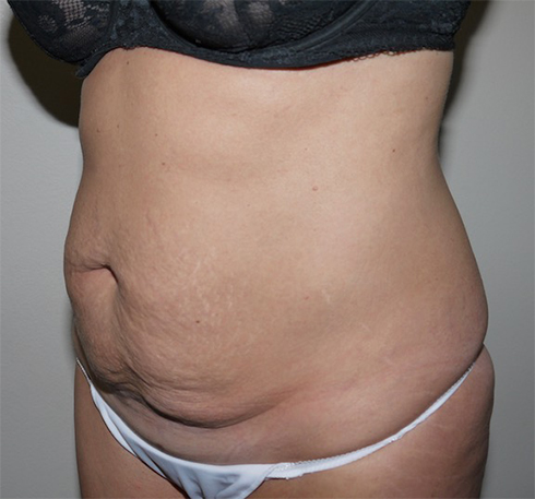 Before Image: Abdominoplasty - left-front-oblique