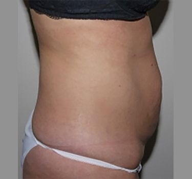 Before Image: Abdominoplasty - right-side