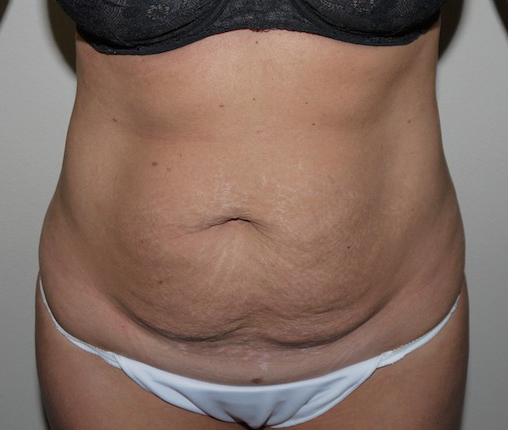Before Image: Abdominoplasty - front
