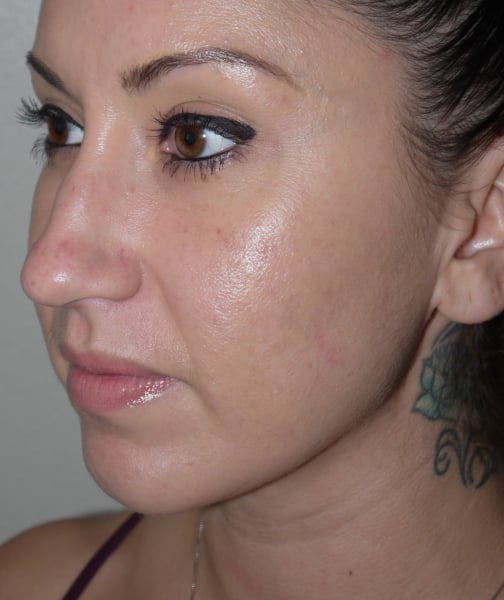 After Image: Liposuction - left-front-oblique