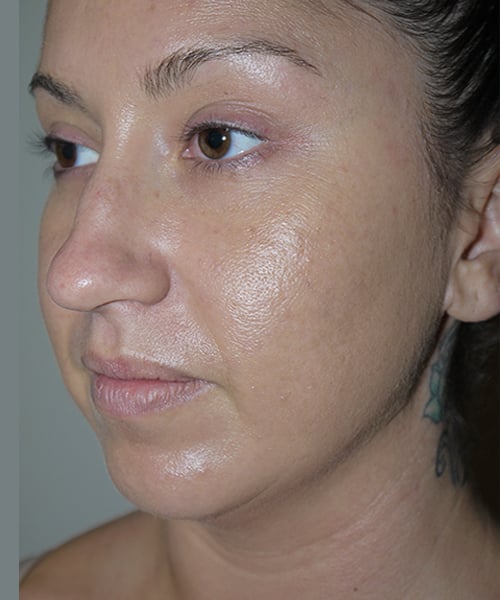 Before Image: Liposuction - left-front-oblique