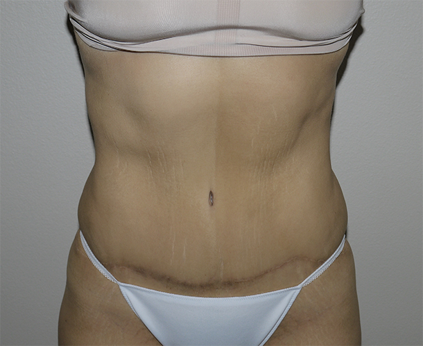 After Image: Abdominoplasty - front