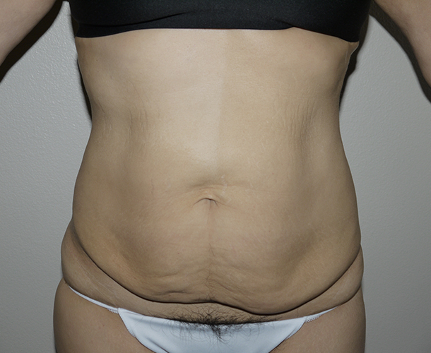 Before Image: Abdominoplasty - front
