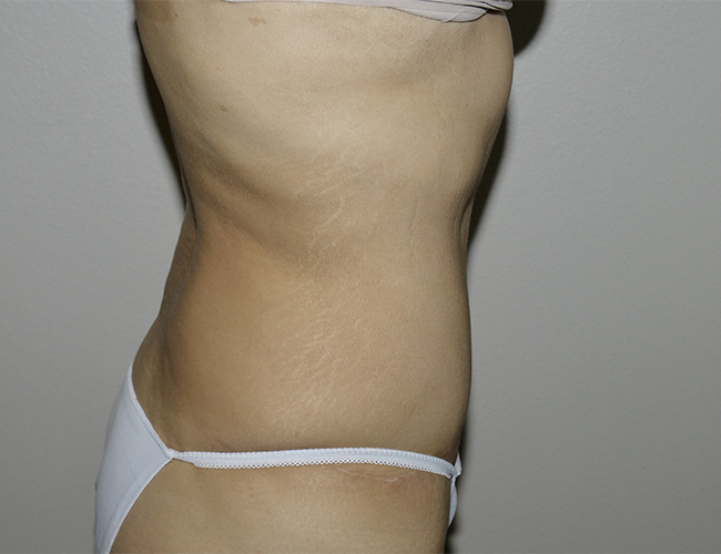 After Image: Abdominoplasty - right-side