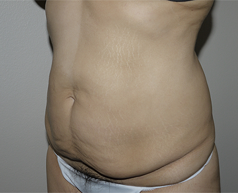 Before Image: Abdominoplasty - left-front-oblique