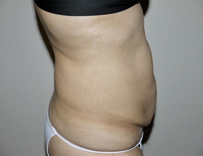 Before Image: Abdominoplasty - right-side