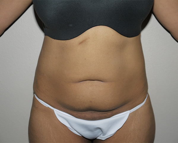 Before Image: Abdominoplasty - front