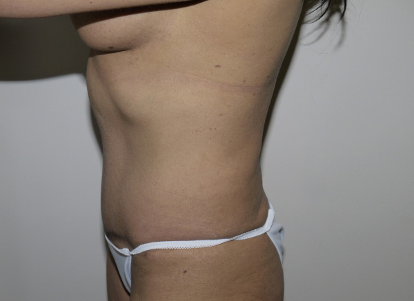 After Image: Abdominoplasty - left-side