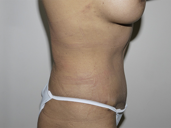 After Image: Abdominoplasty - right-side